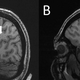 The arrows on the left point to enlarged perivascular spaces seen in the centrum semiovale of someone with chronic migraines. The brain scan on the right with no enlarged spaces is taken from a control with no migraines.